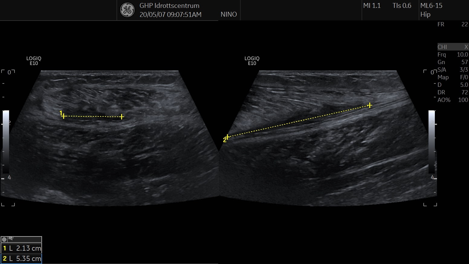 Gastrocnemius ruptur
