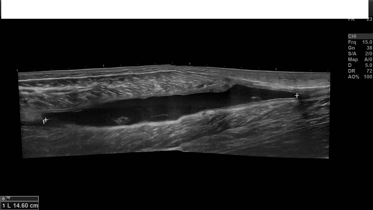 Muscle rupture lower leg