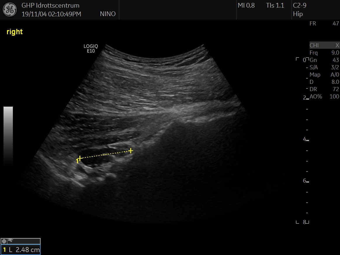 Patient case hip 2