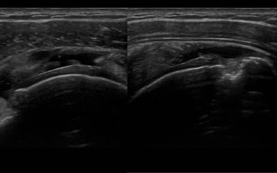 Complete cuff tear for 3 weeks ago.