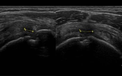 Partial tear in supraspinatus for 4 month ago