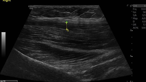 Gluteal pain rupture