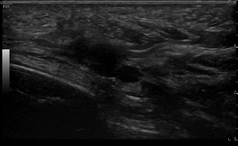 Mortons neuroma long