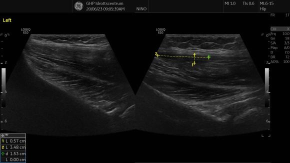 Gluteal pain rupture