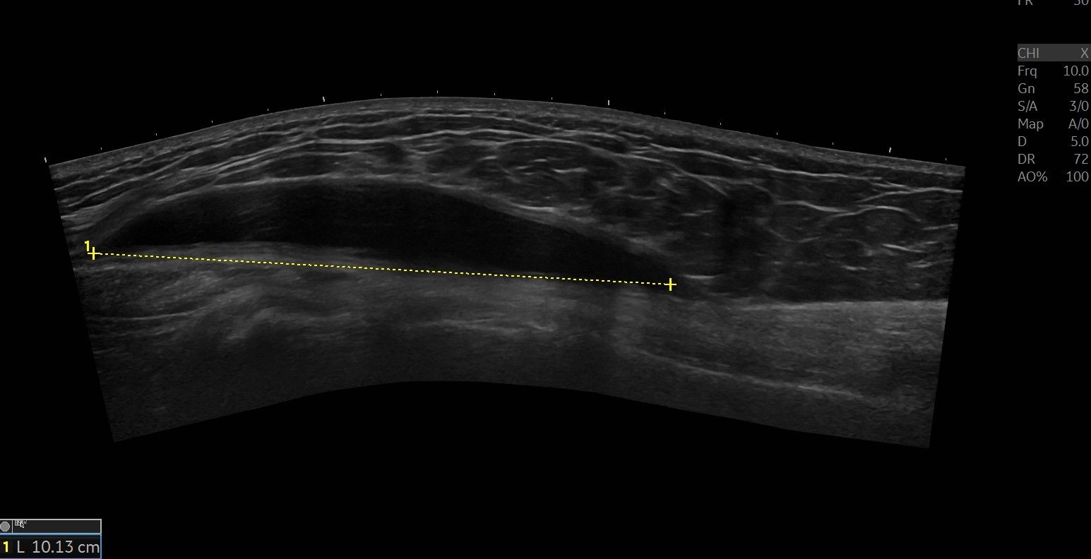 Bursit longitudinell projektion