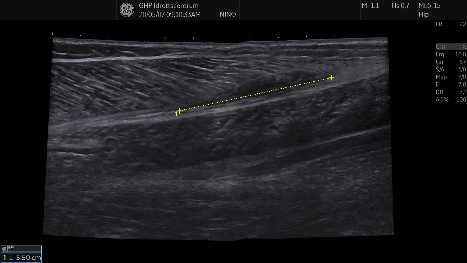 Gastrocnemius ruptur panoramic